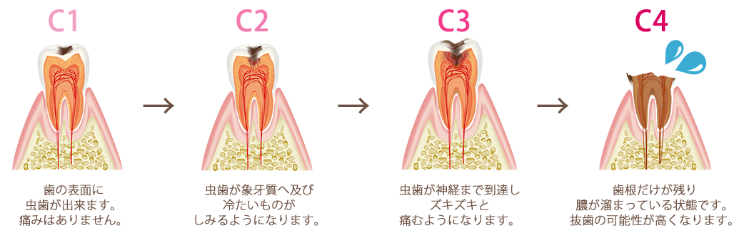 虫歯の原因・進行について