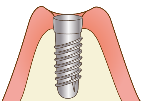 インプラント埋入（一次手術）