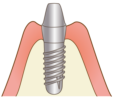 アバットメント装着（二次手術）