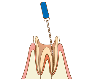 根管治療とは