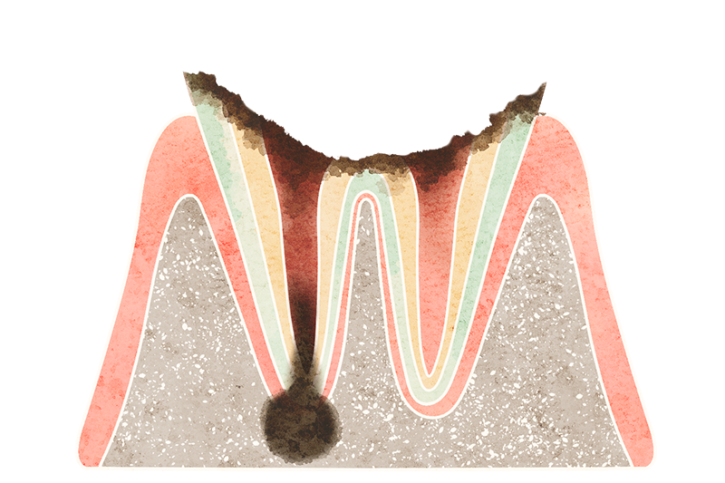 根管治療
