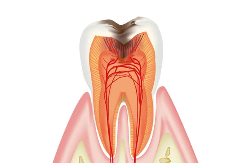 虫歯治療
