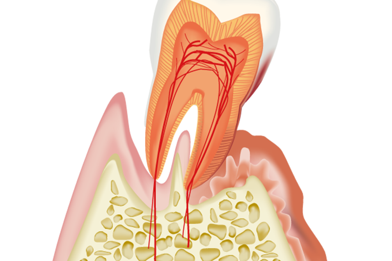 歯周治療